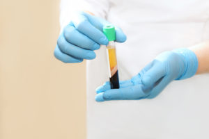 Doctor holding a tube of blood plasma for PRP therapy