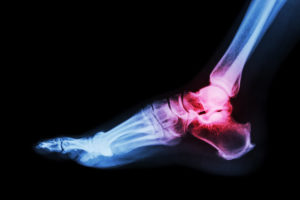 Xray image of an ankle with arthritis
