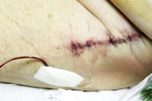Total Joint replacement surgery