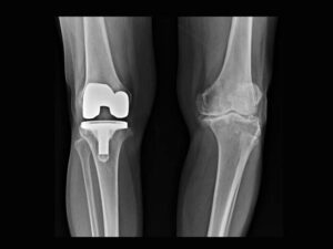 Film x ray : Left knee osteoarthritis disease , Right knee total knee replacement surgery