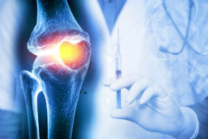 PRP Therapy Before Surgery - All-Star Orthopedics - Austin TX